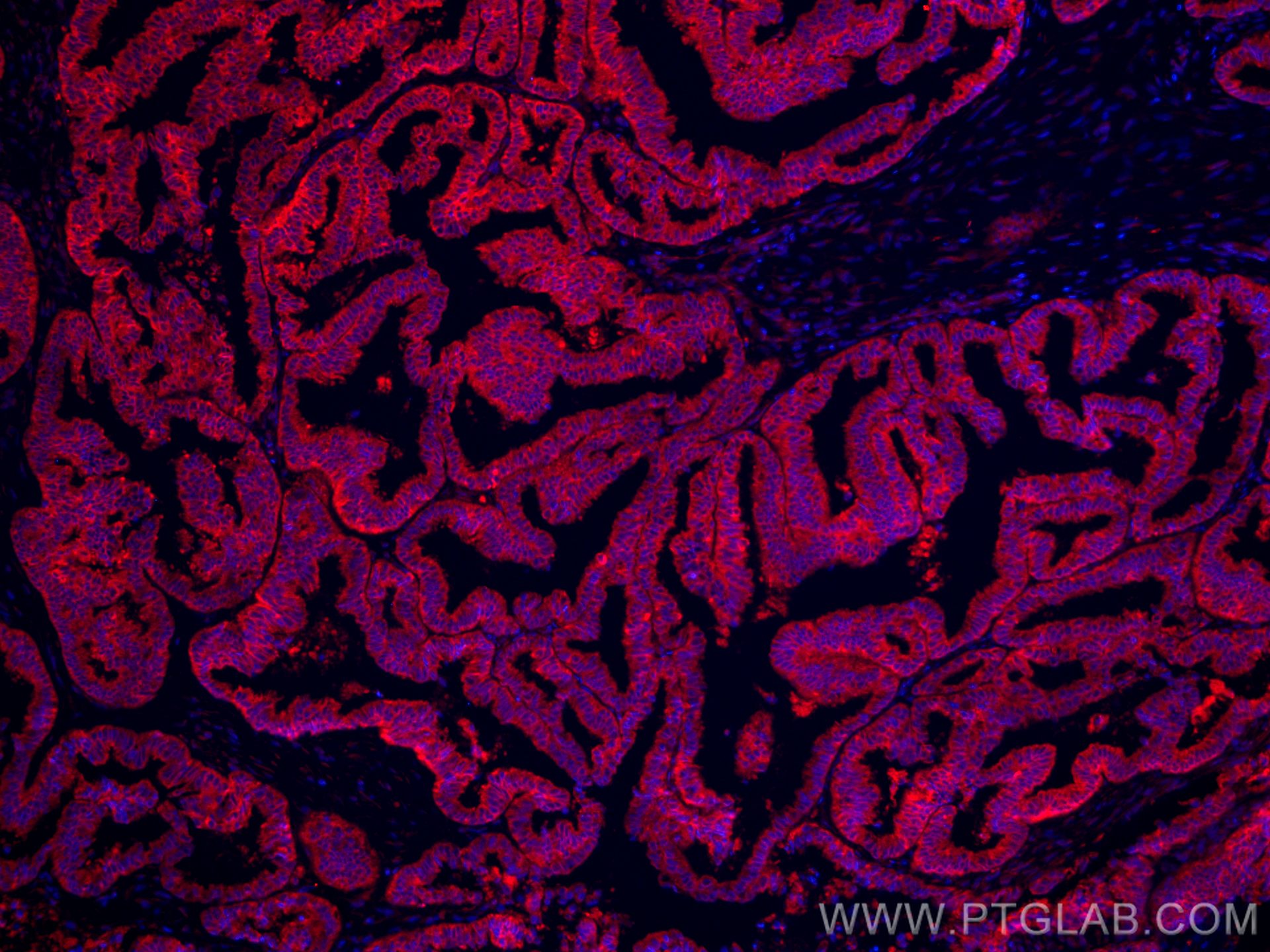 Immunofluorescence (IF) / fluorescent staining of human ovary tumor tissue using CoraLite®594-conjugated PGRMC1 Monoclonal antibody (CL594-66372)