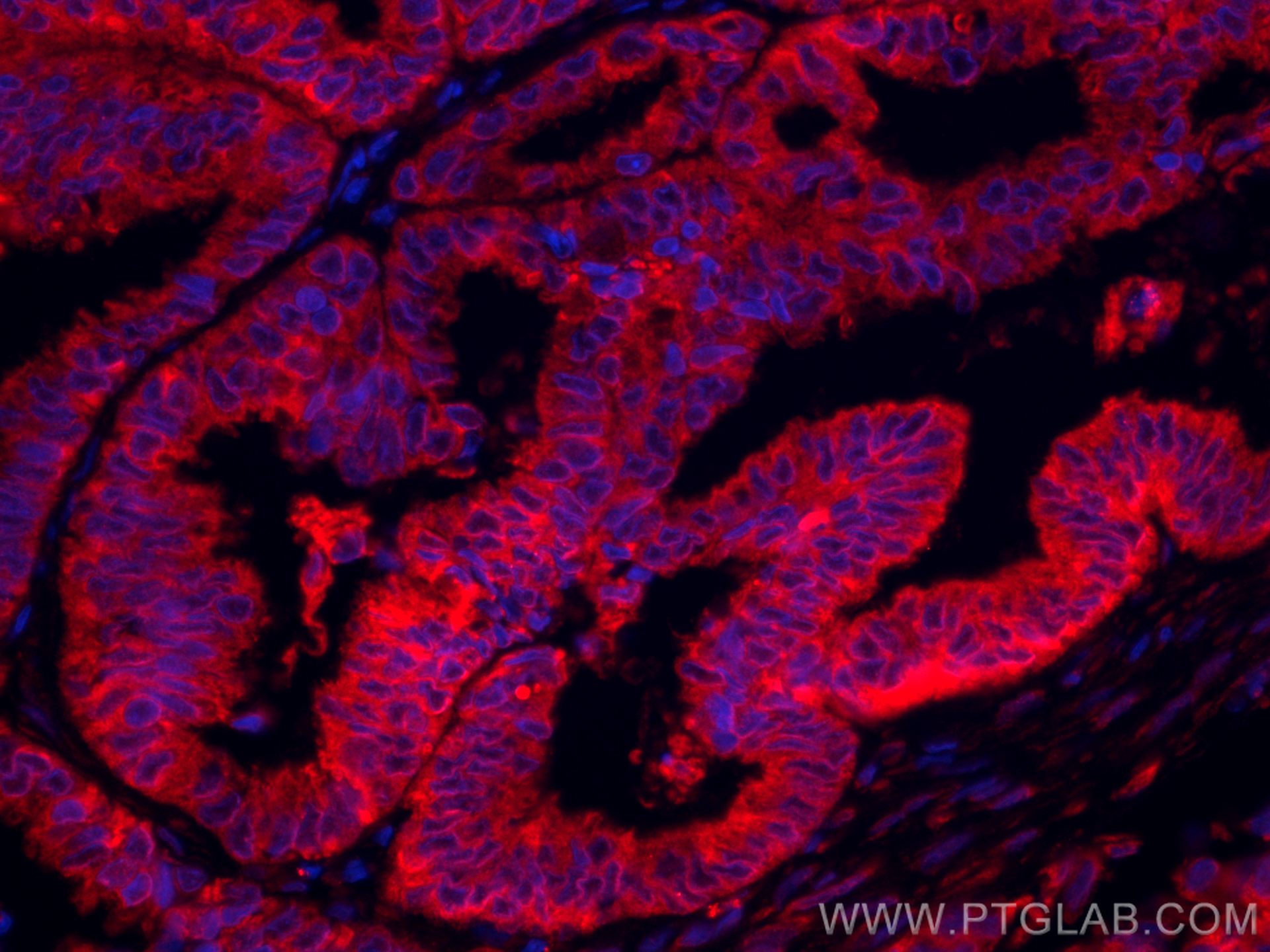 Immunofluorescence (IF) / fluorescent staining of human ovary tumor tissue using CoraLite®594-conjugated PGRMC1 Monoclonal antibody (CL594-66372)