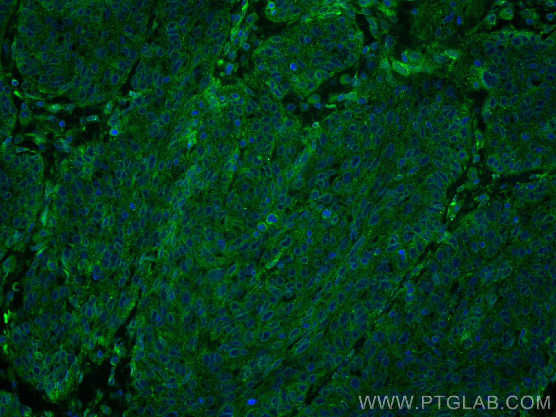 Immunofluorescence (IF) / fluorescent staining of human cervical cancer tissue using PGRMC2 Monoclonal antibody (60249-1-Ig)