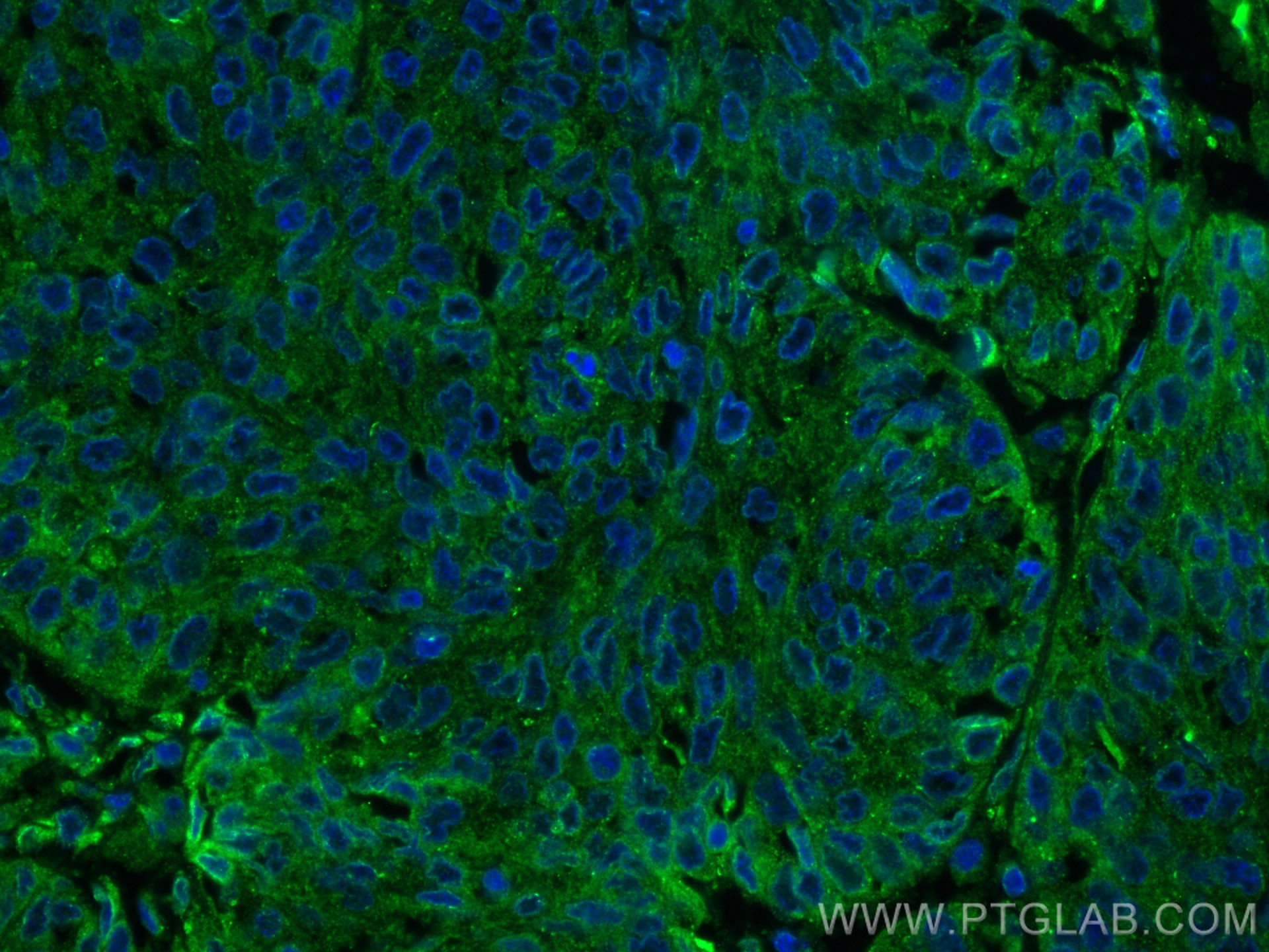 Immunofluorescence (IF) / fluorescent staining of human cervical cancer tissue using PGRMC2 Monoclonal antibody (60249-1-Ig)