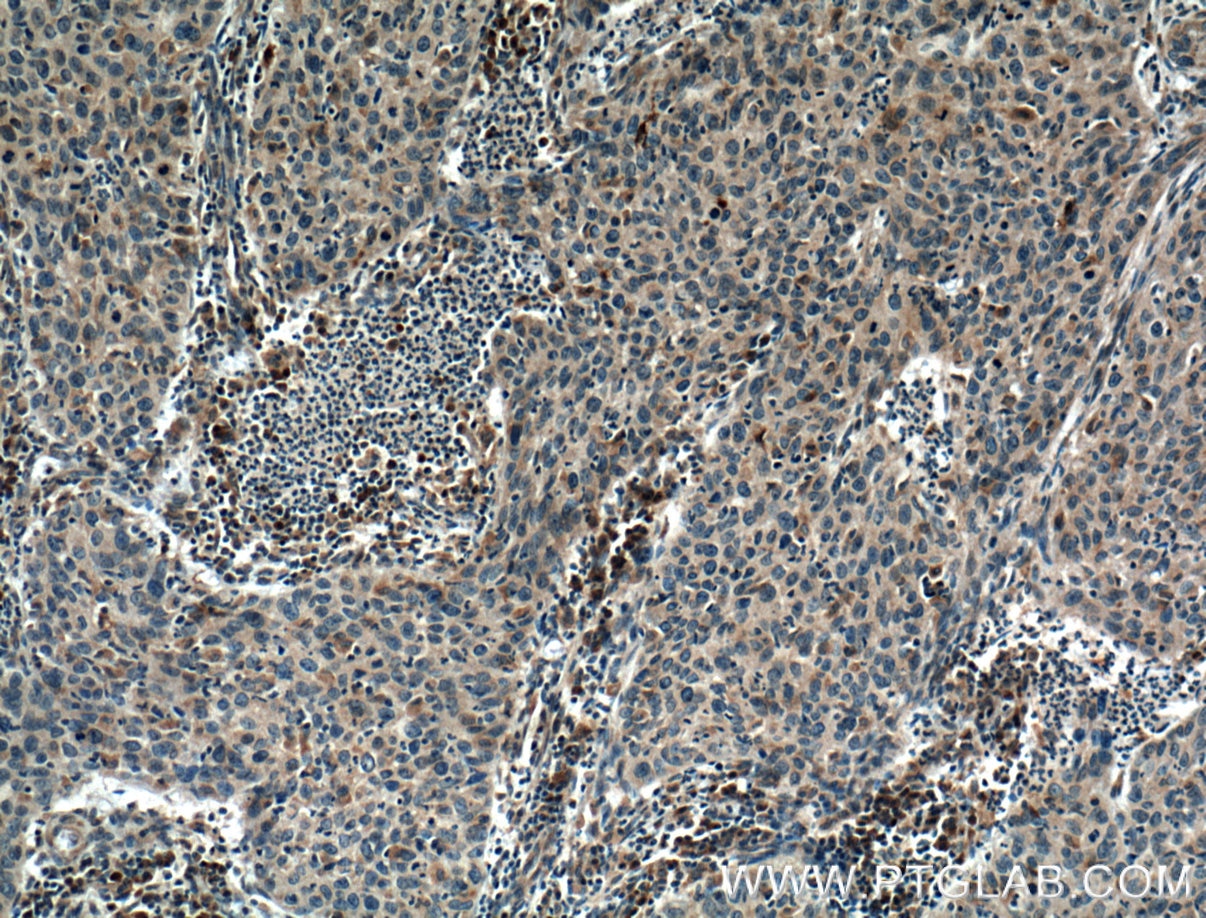 Immunohistochemistry (IHC) staining of human cervical cancer tissue using PGRMC2 Monoclonal antibody (60249-1-Ig)