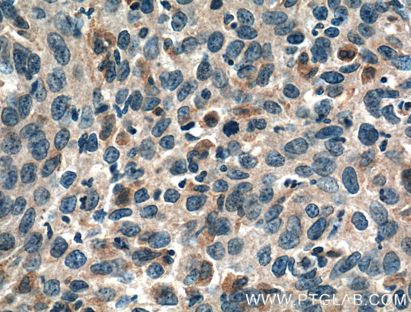 Immunohistochemistry (IHC) staining of human cervical cancer tissue using PGRMC2 Monoclonal antibody (60249-1-Ig)