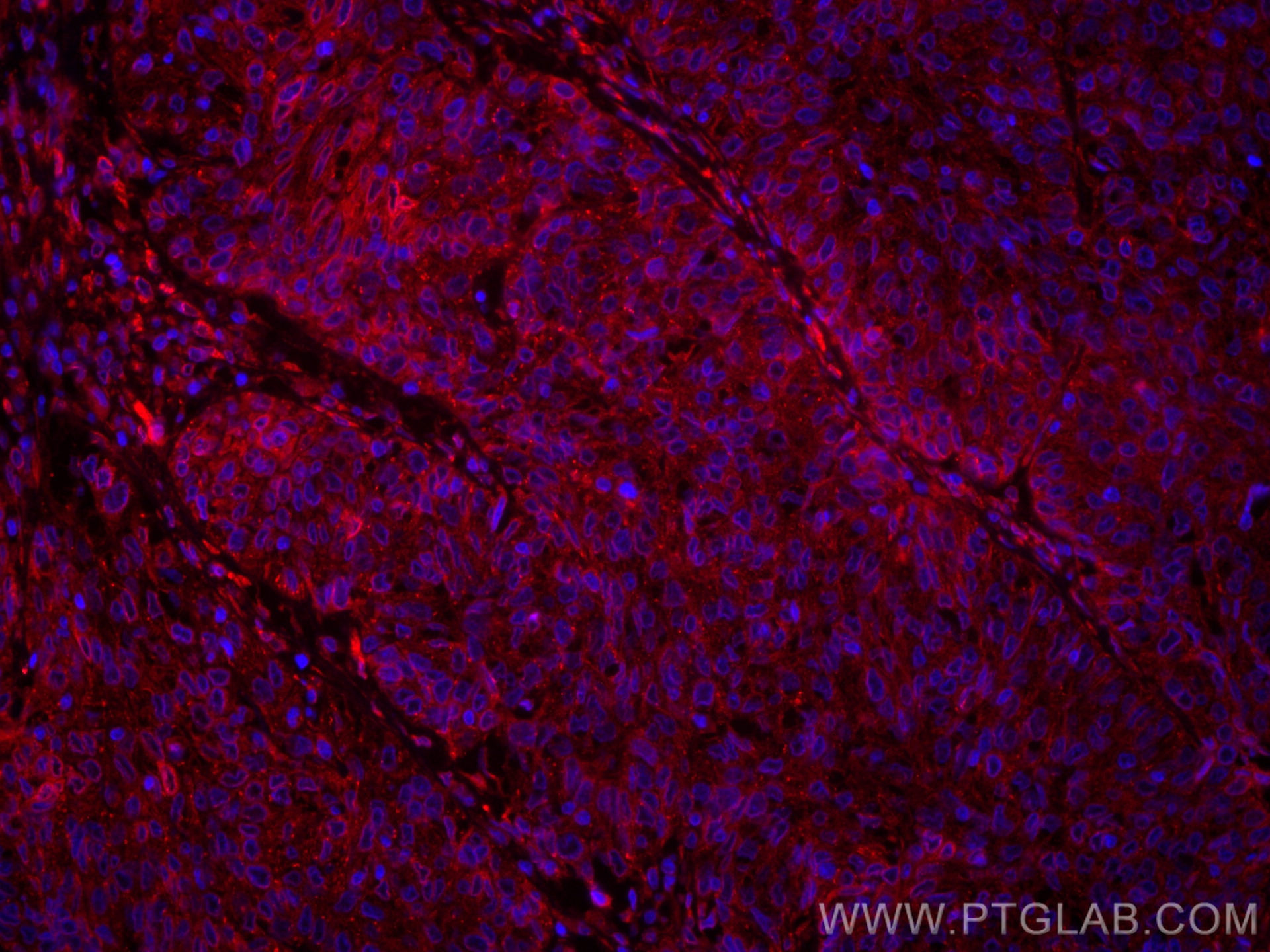 Immunofluorescence (IF) / fluorescent staining of human cervical cancer tissue using CoraLite®594-conjugated PGRMC2 Monoclonal antibody (CL594-60249)