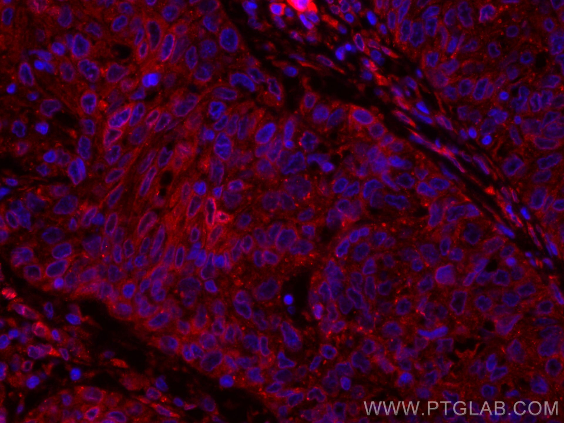 Immunofluorescence (IF) / fluorescent staining of human cervical cancer tissue using CoraLite®594-conjugated PGRMC2 Monoclonal antibody (CL594-60249)