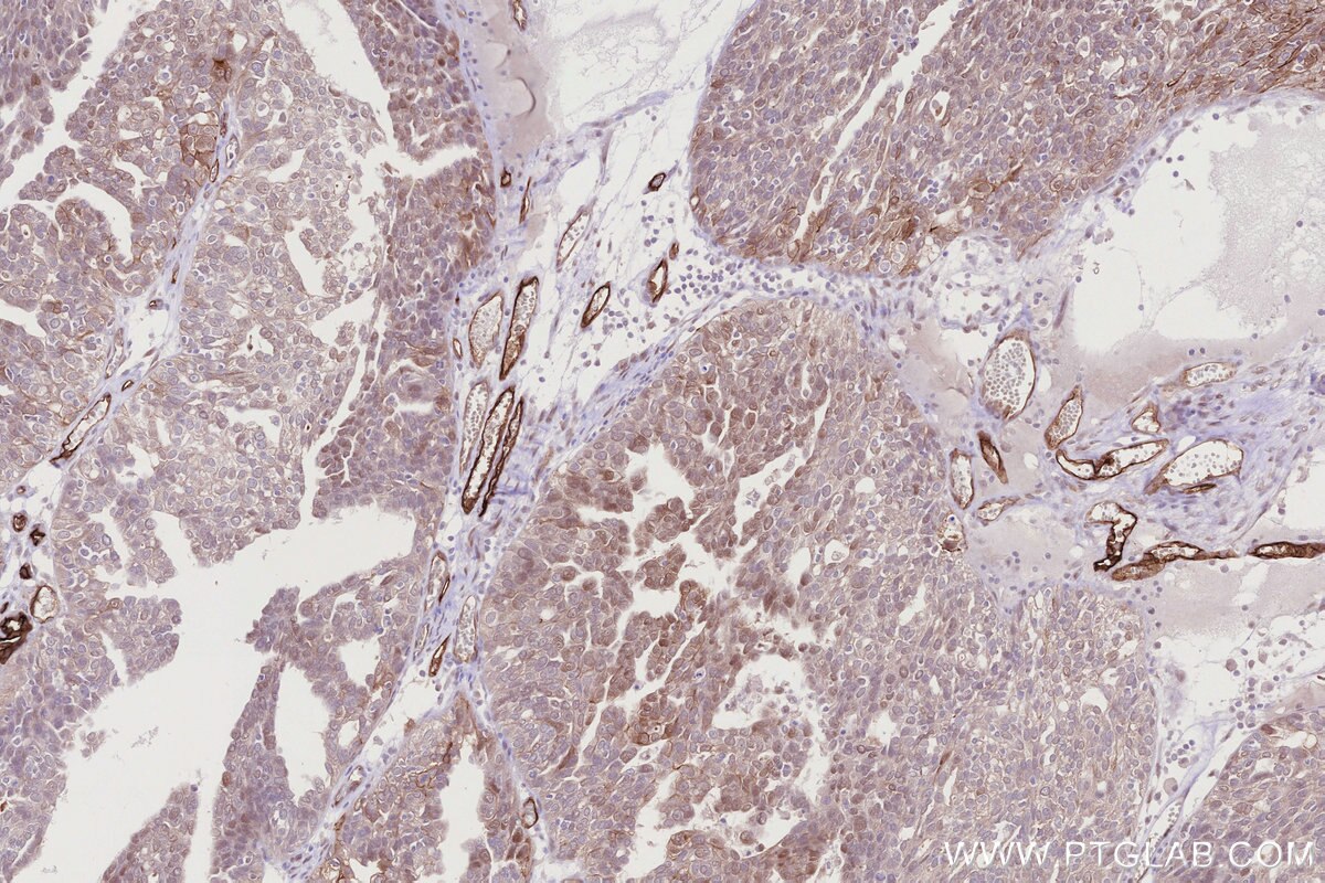 Immunohistochemistry (IHC) staining of human ovary cancer tissue using PGT Recombinant monoclonal antibody (83302-1-RR)