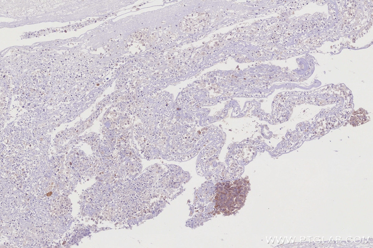 Immunohistochemistry (IHC) staining of human ovary cancer tissue using PGT Recombinant monoclonal antibody (83302-1-RR)