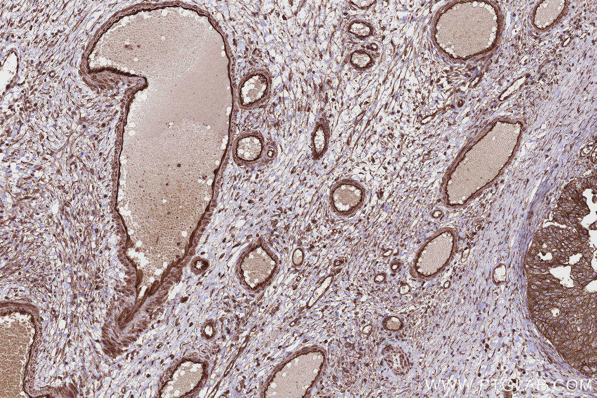 Immunohistochemistry (IHC) staining of human ovary cancer tissue using PHACTR4 Polyclonal antibody (13408-1-AP)