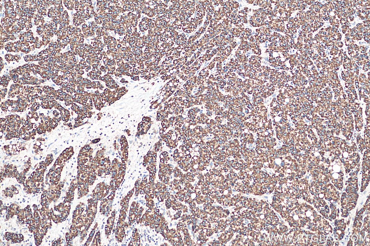 Immunohistochemistry (IHC) staining of human liver cancer tissue using Prohibitin Polyclonal antibody (10787-1-AP)