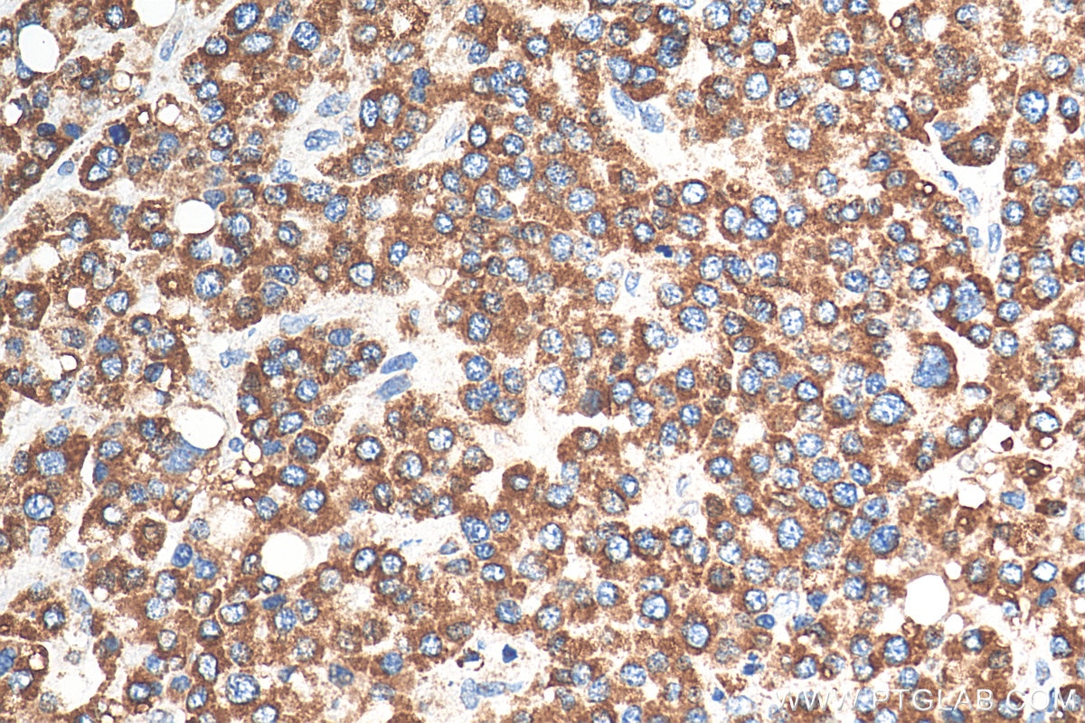 Immunohistochemistry (IHC) staining of human liver cancer tissue using Prohibitin Polyclonal antibody (10787-1-AP)