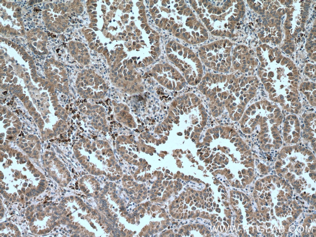 Immunohistochemistry (IHC) staining of human lung cancer tissue using PHEX Monoclonal antibody (66934-1-Ig)