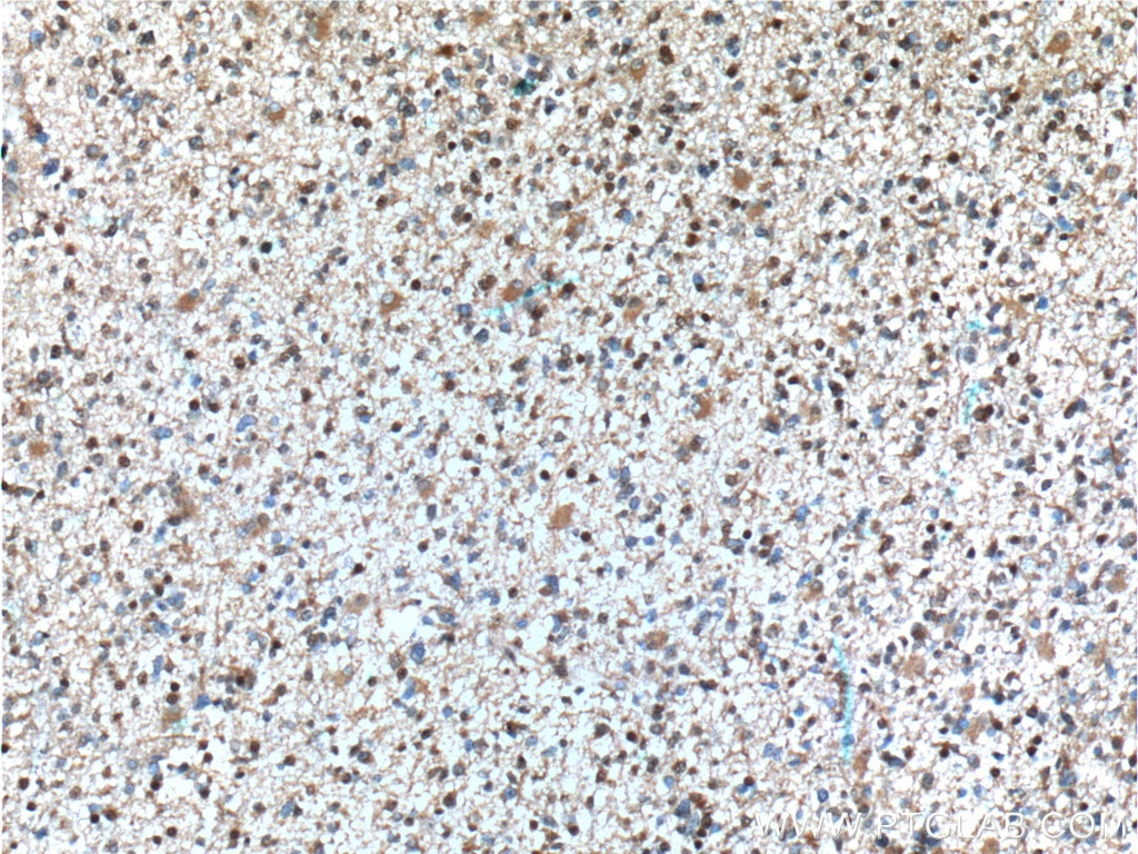 IHC staining of human gliomas using 66341-1-Ig