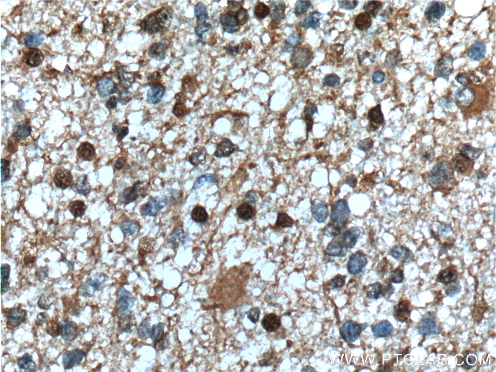 Immunohistochemistry (IHC) staining of human gliomas tissue using PHF10 Monoclonal antibody (66341-1-Ig)