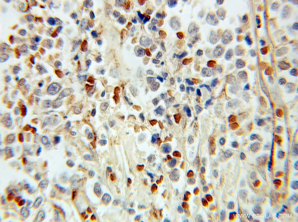 Immunohistochemistry (IHC) staining of human lymphoma tissue using PHF11 Polyclonal antibody (10898-1-AP)