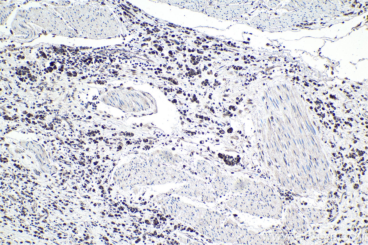 Immunohistochemistry (IHC) staining of human stomach cancer tissue using PHF14 Polyclonal antibody (24787-1-AP)