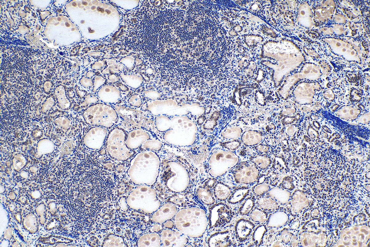 Immunohistochemistry (IHC) staining of human thyroid cancer tissue using PHF14 Polyclonal antibody (24787-1-AP)