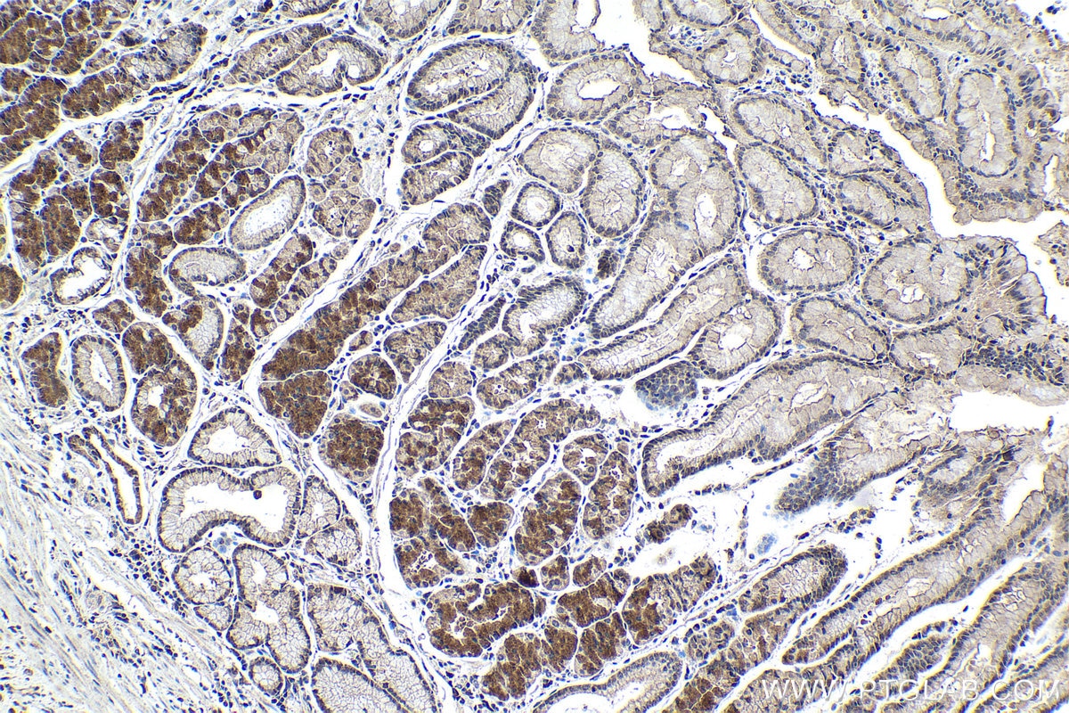 Immunohistochemistry (IHC) staining of human stomach cancer tissue using PHF14 Polyclonal antibody (24787-1-AP)