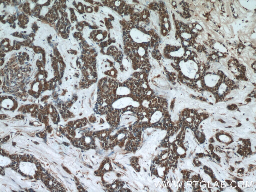 IHC staining of human cervical cancer using 24624-1-AP