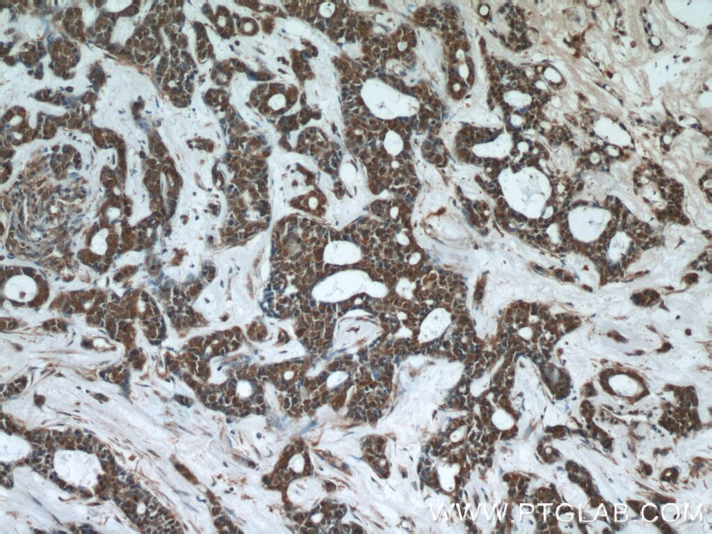 Immunohistochemistry (IHC) staining of human cervical cancer tissue using PHF2 Polyclonal antibody (24624-1-AP)