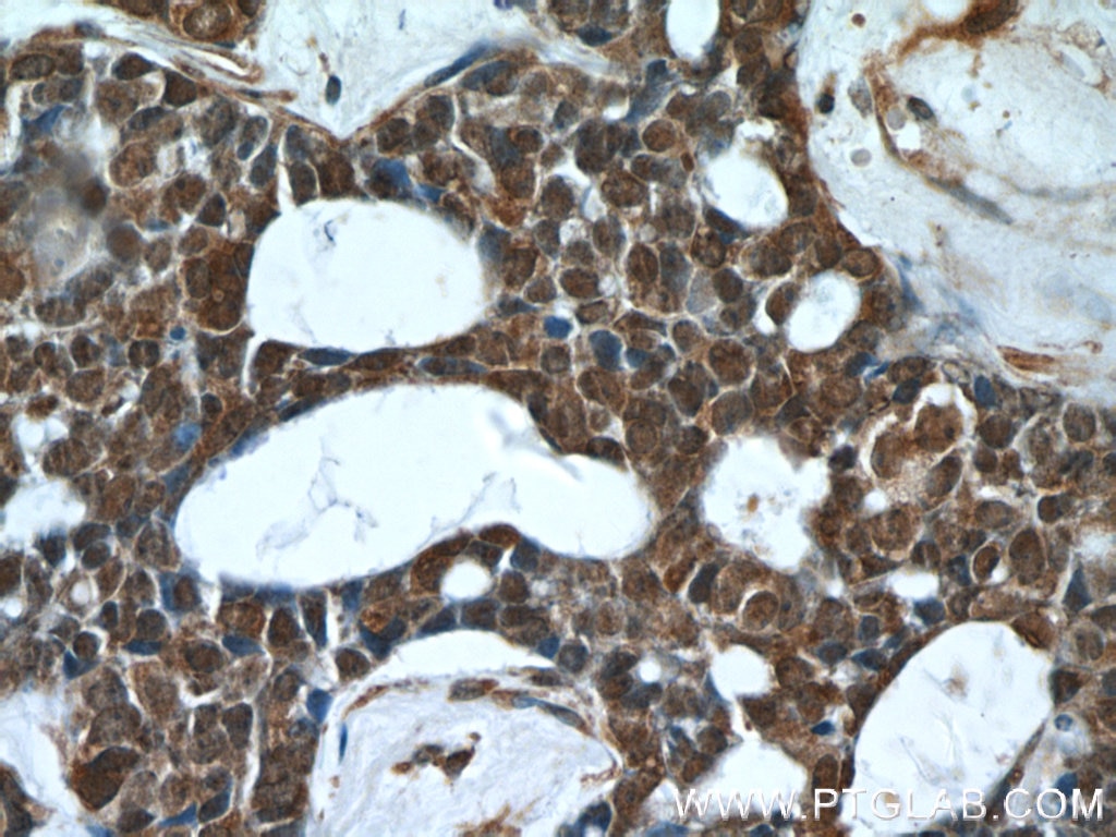 Immunohistochemistry (IHC) staining of human cervical cancer tissue using PHF2 Polyclonal antibody (24624-1-AP)