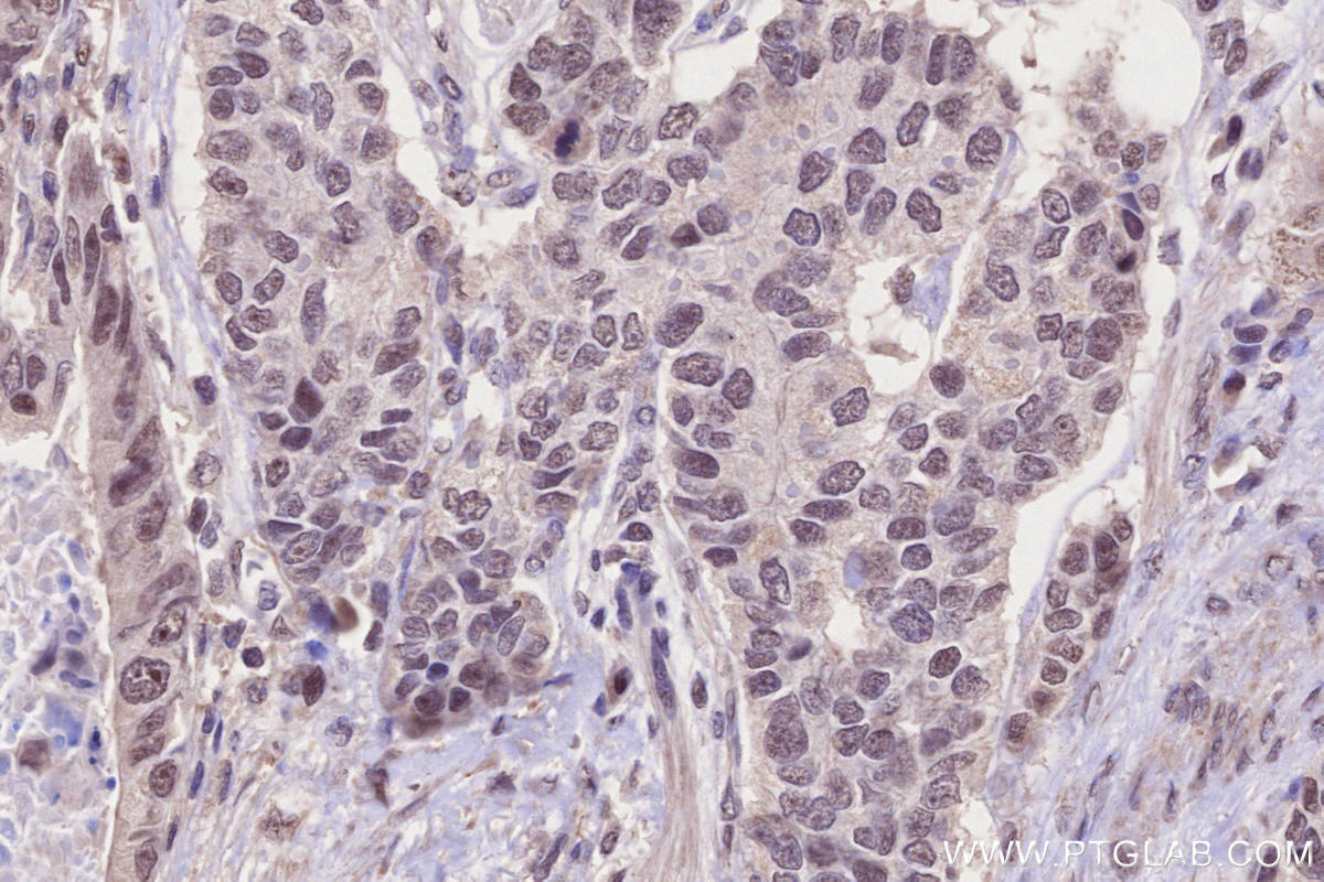 Immunohistochemistry (IHC) staining of human stomach cancer tissue using PHF6 Polyclonal antibody (51062-1-AP)
