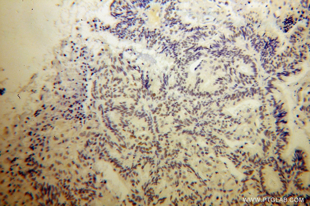 Immunohistochemistry (IHC) staining of human ovary tumor tissue using PHF6 Polyclonal antibody (51062-1-AP)