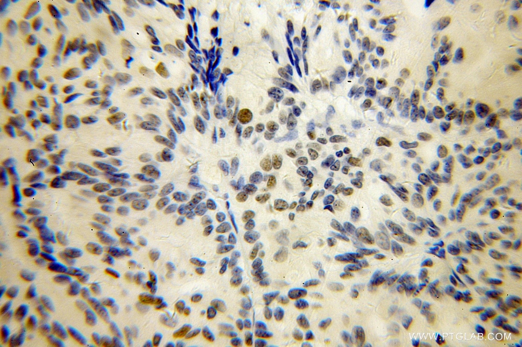 Immunohistochemistry (IHC) staining of human ovary tumor tissue using PHF6 Polyclonal antibody (51062-1-AP)