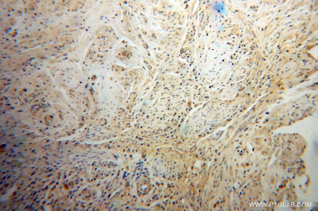 Immunohistochemistry (IHC) staining of human cervical cancer tissue using PHF6 Polyclonal antibody (51062-1-AP)