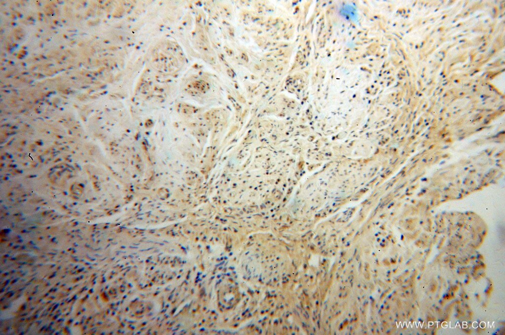 Immunohistochemistry (IHC) staining of human cervical cancer tissue using PHF6 Polyclonal antibody (51062-1-AP)