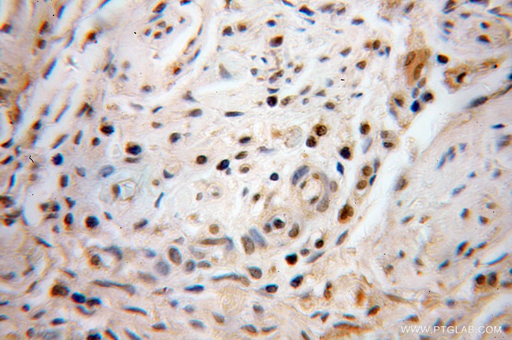 IHC staining of human cervical cancer using 51062-1-AP