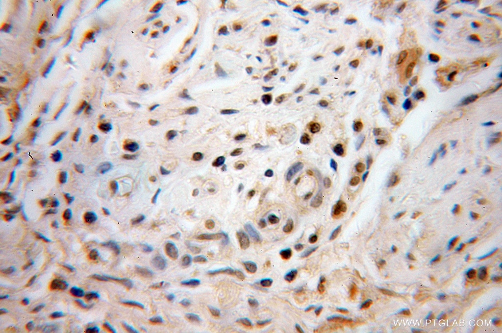 Immunohistochemistry (IHC) staining of human cervical cancer tissue using PHF6 Polyclonal antibody (51062-1-AP)