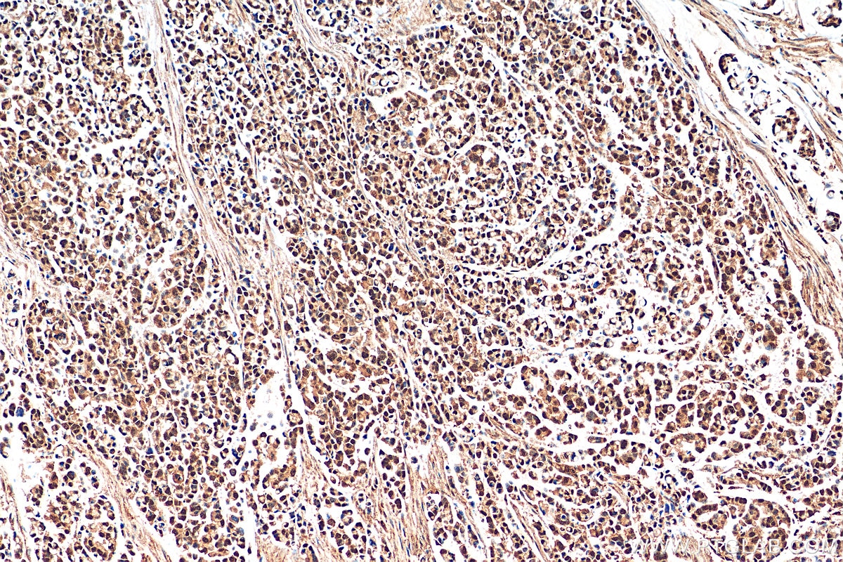 Immunohistochemistry (IHC) staining of human colon cancer tissue using PHF8 Polyclonal antibody (29516-1-AP)