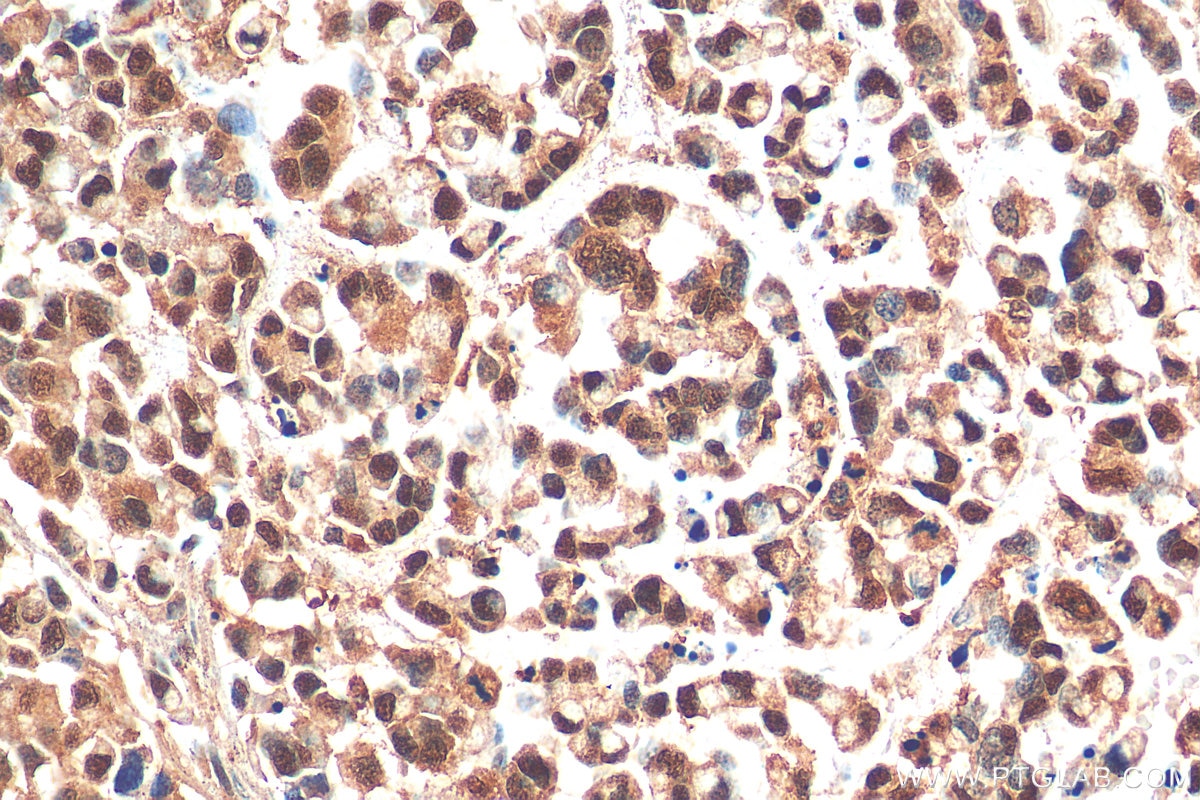 Immunohistochemistry (IHC) staining of human colon cancer tissue using PHF8 Polyclonal antibody (29516-1-AP)