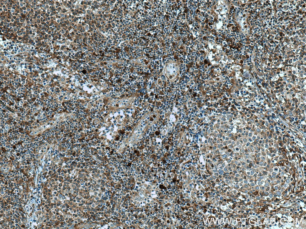 Immunohistochemistry (IHC) staining of human lymphoma tissue using PHGDH Polyclonal antibody (14719-1-AP)