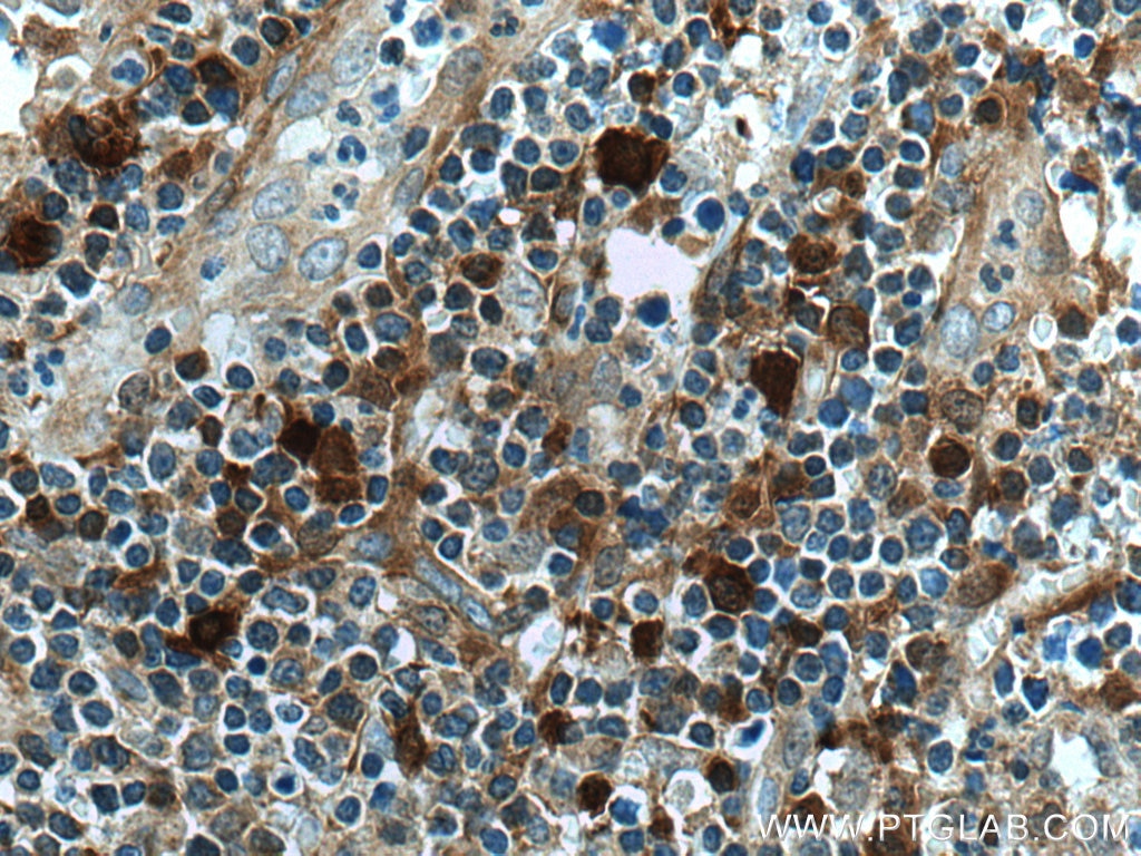 IHC staining of human lymphoma using 14719-1-AP