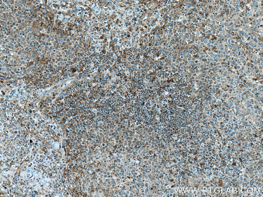 Immunohistochemistry (IHC) staining of human lymphoma tissue using PHGDH Polyclonal antibody (14719-1-AP)