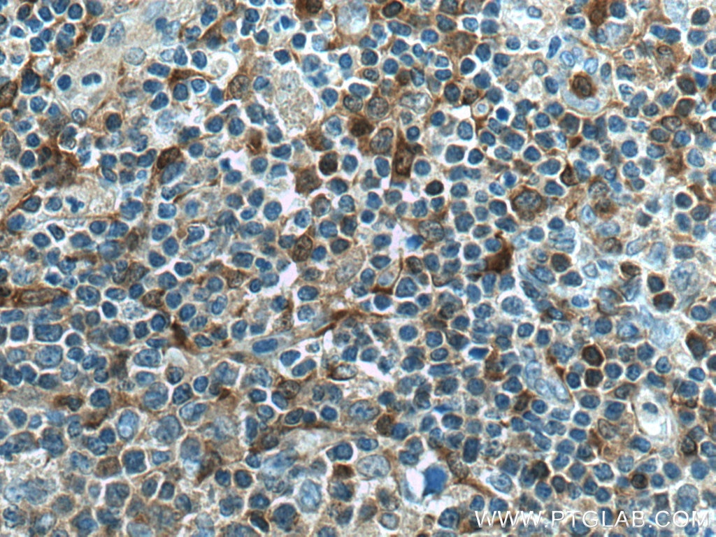 Immunohistochemistry (IHC) staining of human lymphoma tissue using PHGDH Polyclonal antibody (14719-1-AP)