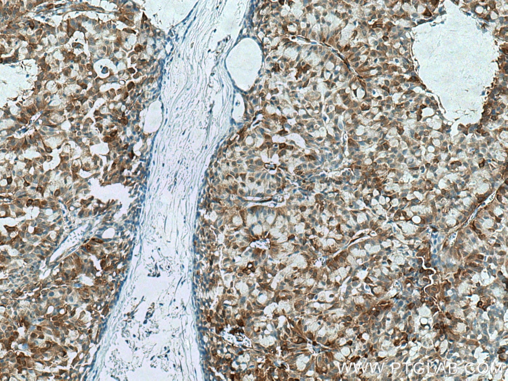 Immunohistochemistry (IHC) staining of human breast hyperplasia tissue using PHGDH Polyclonal antibody (14719-1-AP)