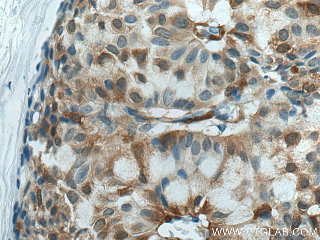 Immunohistochemistry (IHC) staining of human breast hyperplasia tissue using PHGDH Polyclonal antibody (14719-1-AP)