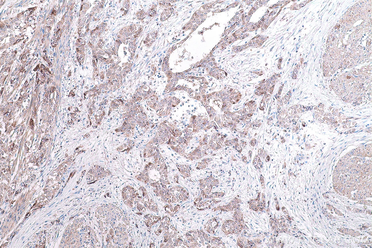 Immunohistochemistry (IHC) staining of human urothelial carcinoma tissue using PHGDH Monoclonal antibody (67591-1-Ig)