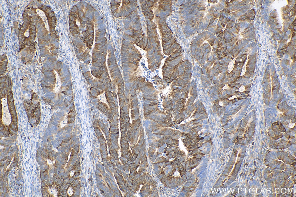 Immunohistochemistry (IHC) staining of human colon cancer tissue using PHGDH Recombinant antibody (81986-1-RR)