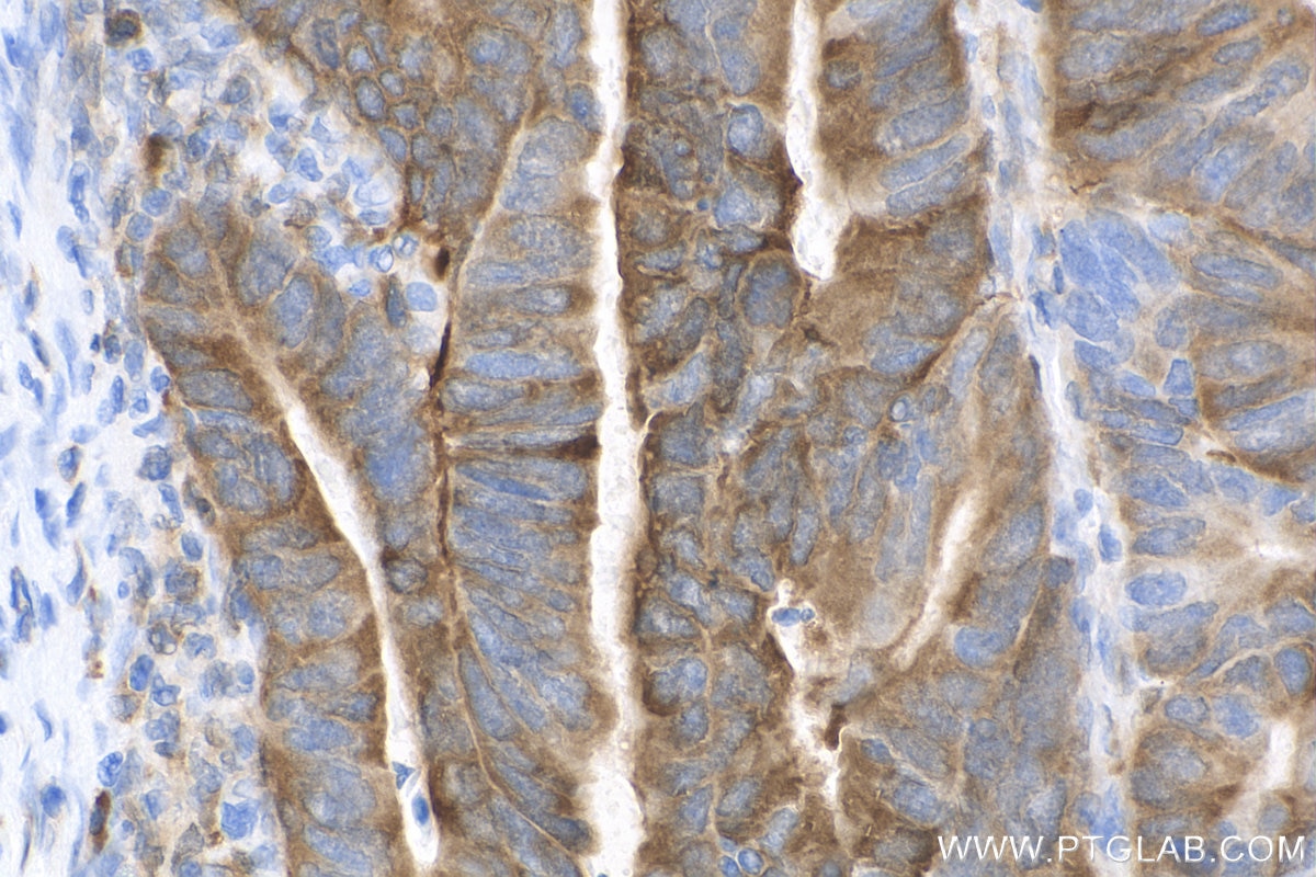 IHC staining of human colon cancer using 81986-1-RR