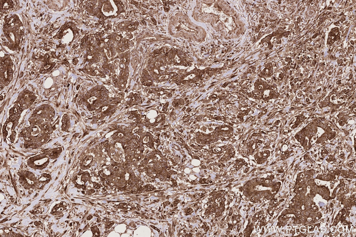 Immunohistochemistry (IHC) staining of human rectal cancer tissue using PHKB Polyclonal antibody (13400-1-AP)