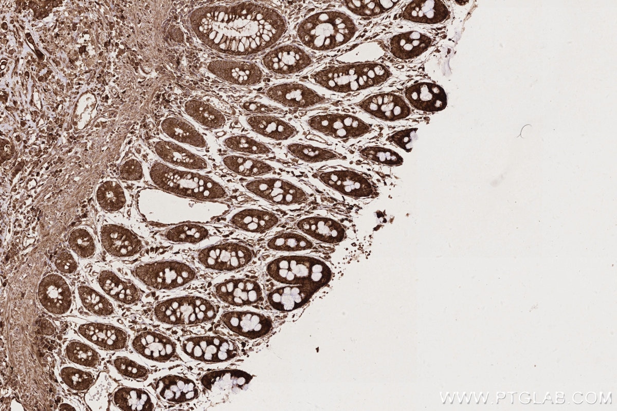 Immunohistochemistry (IHC) staining of human rectal cancer tissue using PHKB Polyclonal antibody (13400-1-AP)