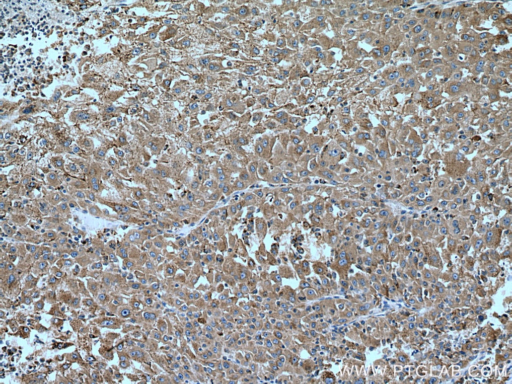 Immunohistochemistry (IHC) staining of human liver cancer tissue using PHKG2 Polyclonal antibody (15109-1-AP)