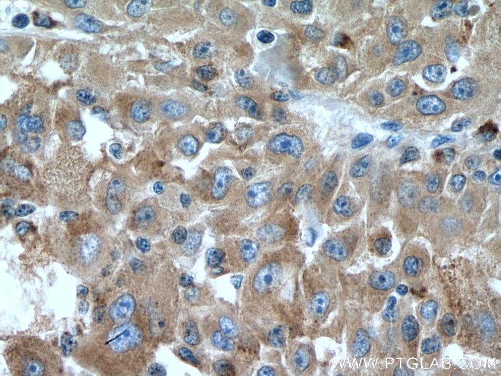 Immunohistochemistry (IHC) staining of human liver cancer tissue using PHKG2 Polyclonal antibody (15109-1-AP)