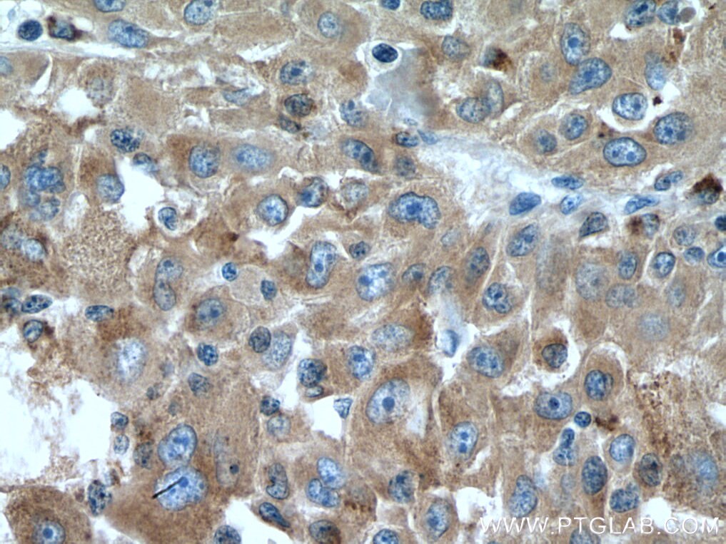 IHC staining of human liver cancer using 15109-1-AP