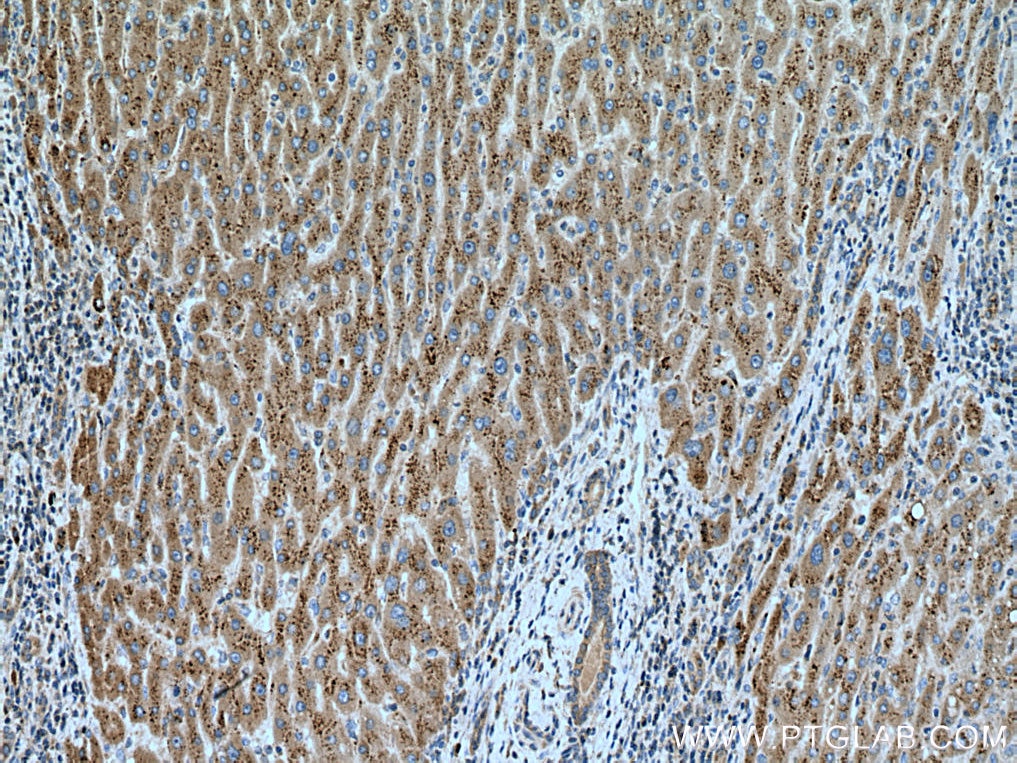 Immunohistochemistry (IHC) staining of human liver cancer tissue using PHKG2 Polyclonal antibody (15109-1-AP)