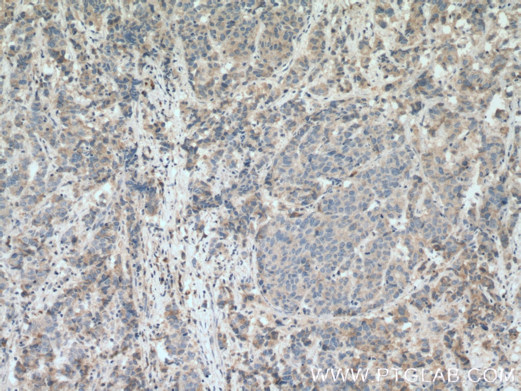 Immunohistochemistry (IHC) staining of human prostate cancer tissue using PHLDA2 Polyclonal antibody (14661-1-AP)