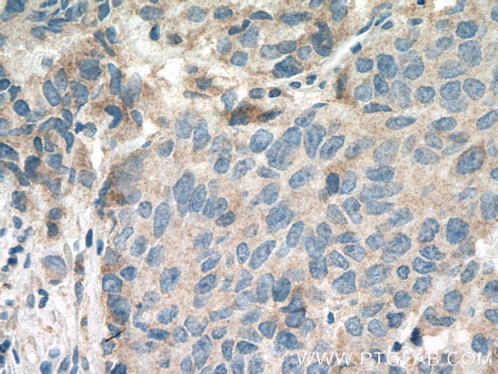 Immunohistochemistry (IHC) staining of human prostate cancer tissue using PHLDA2 Polyclonal antibody (14661-1-AP)