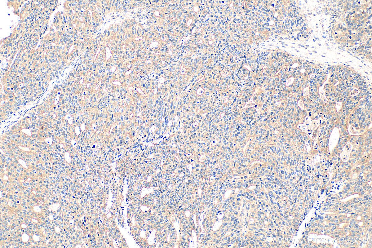 Immunohistochemistry (IHC) staining of human ovary tumor tissue using PHLDB1 Polyclonal antibody (33225-1-AP)